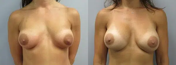 breast implant exchange before and after photo by main line institute of plastic surgery in wynnewood pa