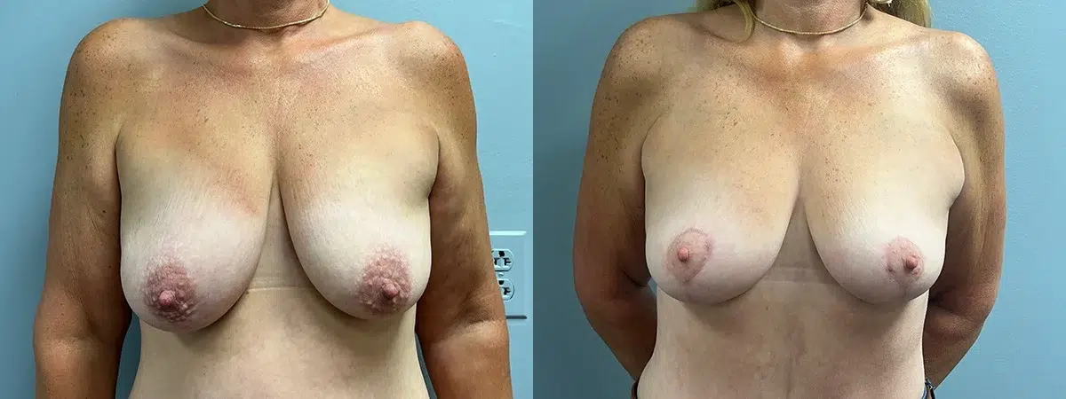breast lift before and after photo by main line institute of plastic surgery in wynnewood pa