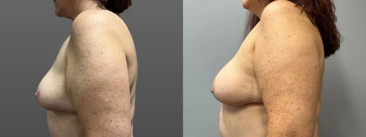 breast lift before and after photo by main line institute of plastic surgery in wynnewood pa