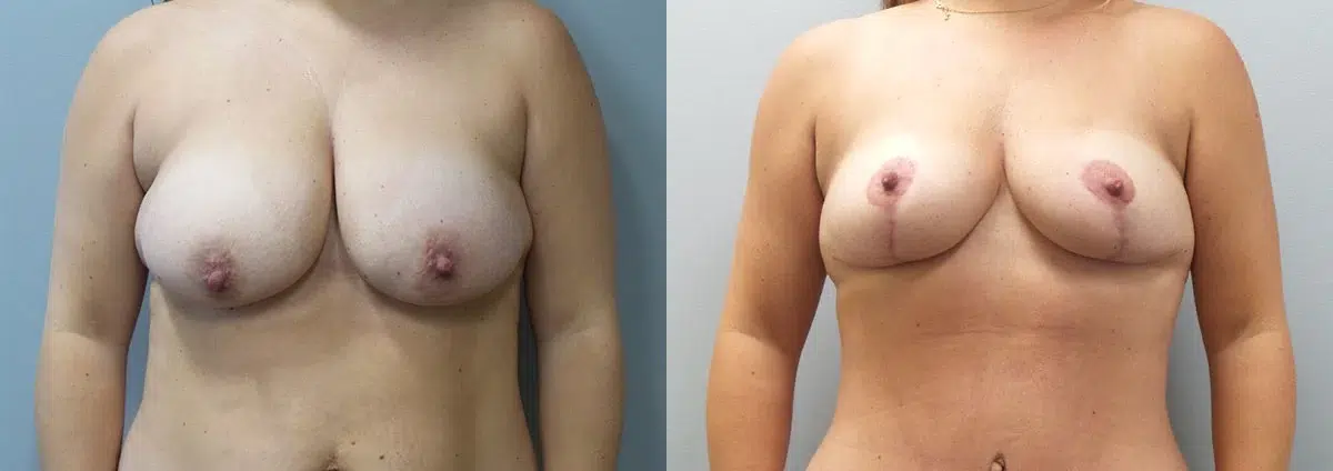 breast lift before and after photo by main line institute of plastic surgery in wynnewood pa