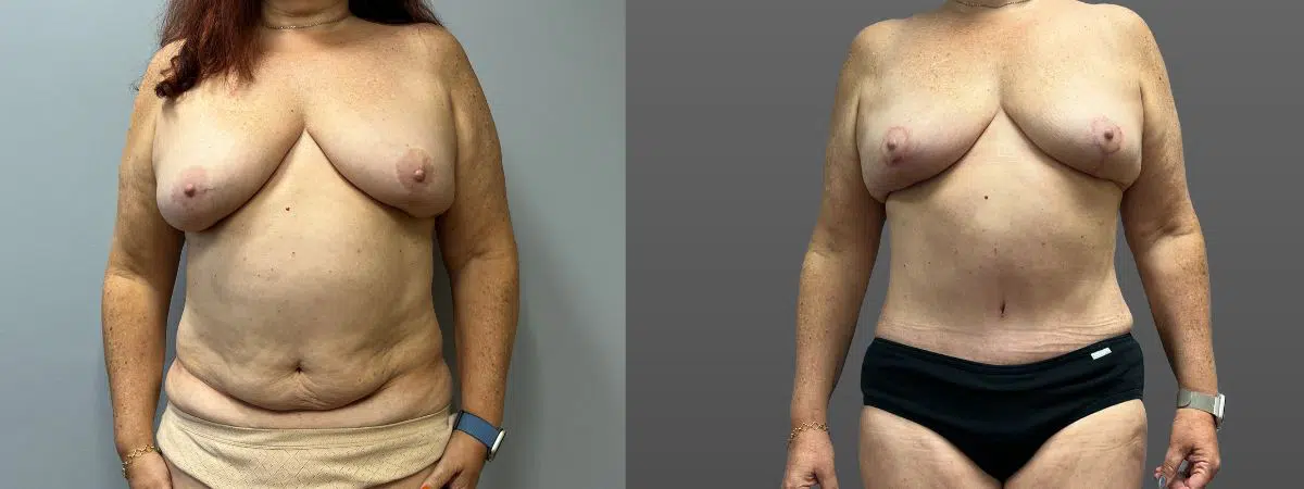 mommy makeover before and after photo by main line institute of plastic surgery in wynnewood pa