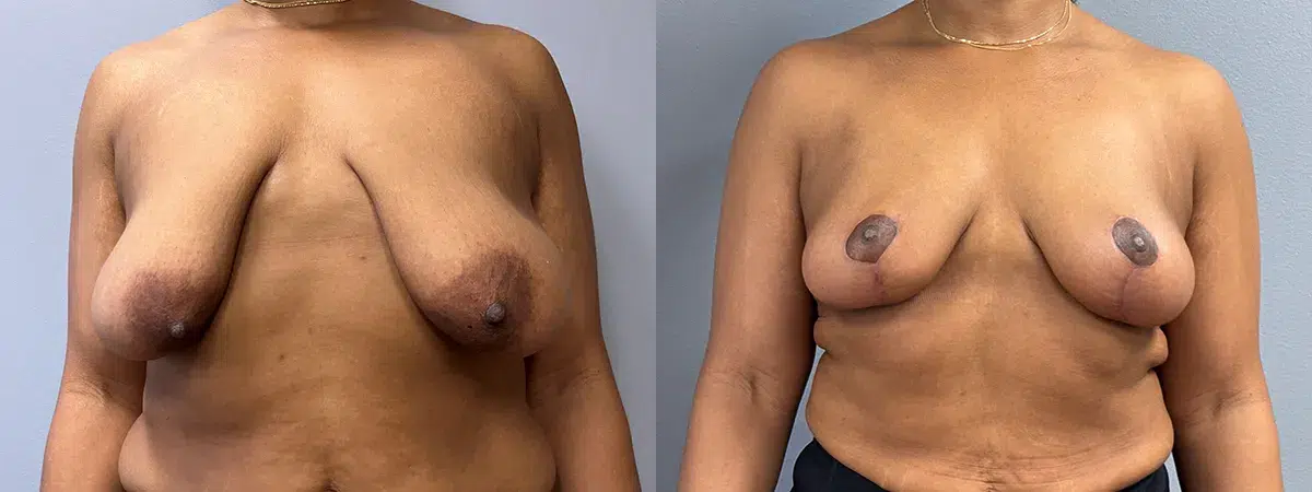breast lift before and after photo by main line institute of plastic surgery in wynnewood pa