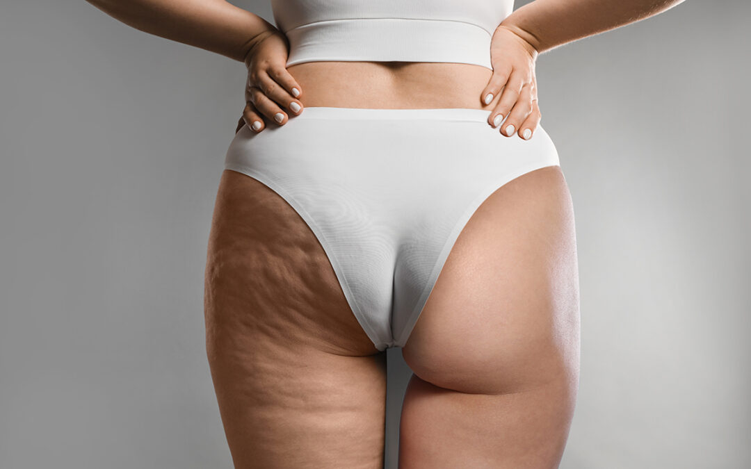 Cellulite Reduction – Reaction