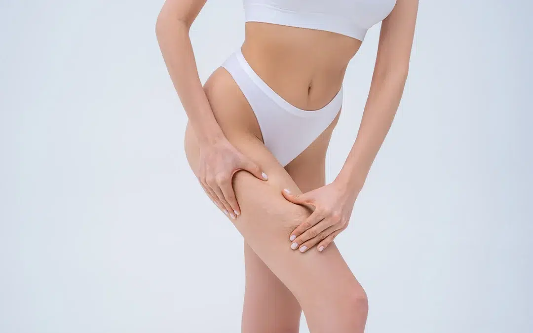Cellulite – Reaction by Viora