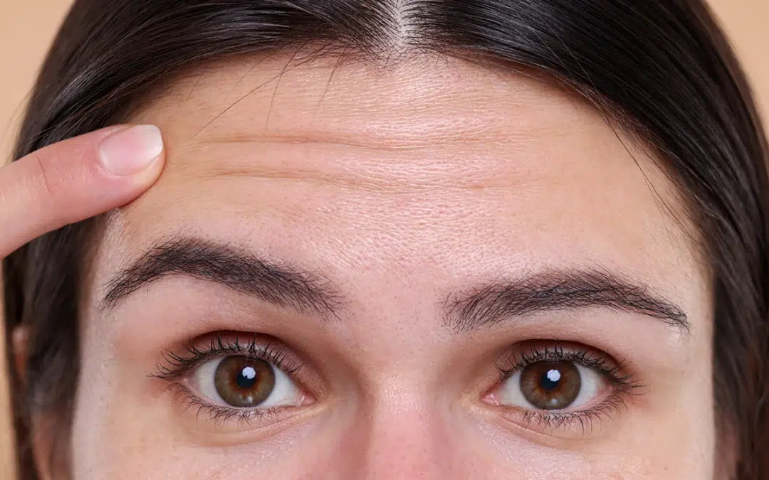 Using Botox to Treat Vertical Brow Wrinkles