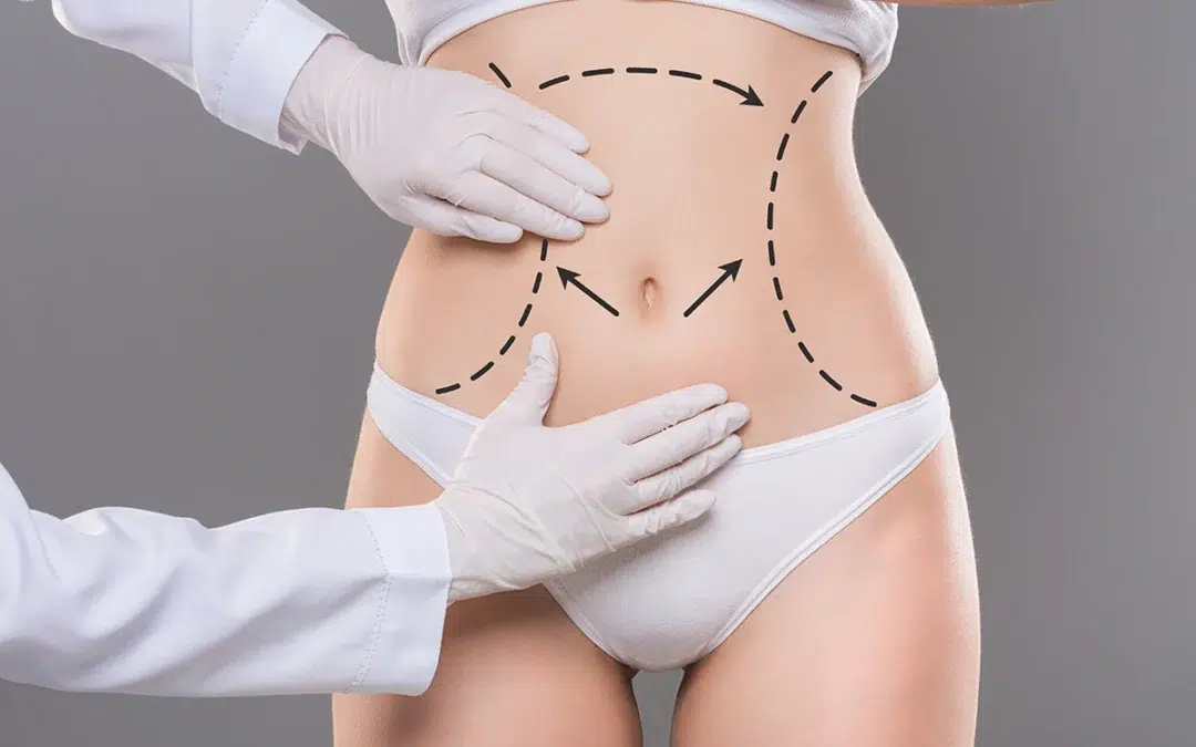 What to Expect During and After Abdominoplasty (Tummy Tuck) Surgery