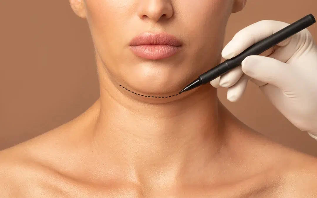 Facelift – Technical Steps