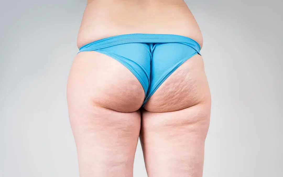 Cellulite Treatment – Viora Skin Treatment