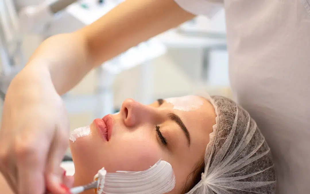 What to Expect with a Chemical Peel