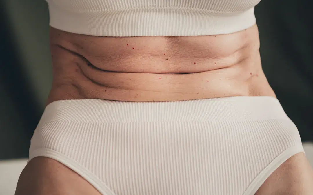 Sick of Drooping Skin? A Body Lift Is a Comprehensive Solution