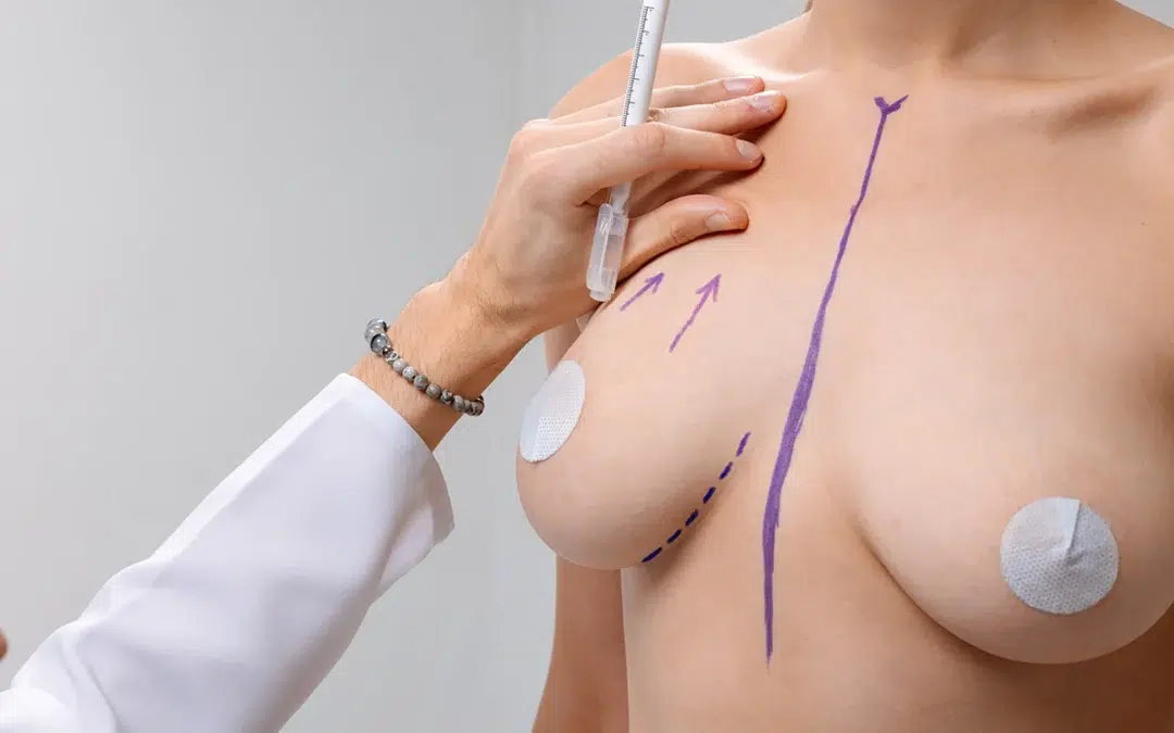 Breast Lift – Ptosis Grade