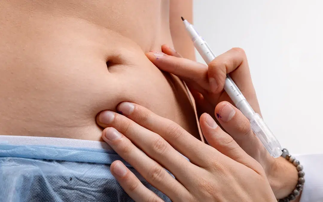How to Prepare for a Mini Tummy Tuck