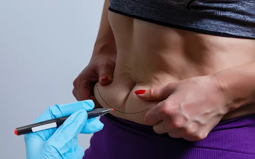 Reasons for Getting a Tummy Tuck