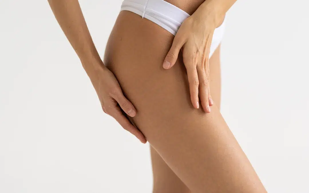 Thigh Lift – Recovery Steps