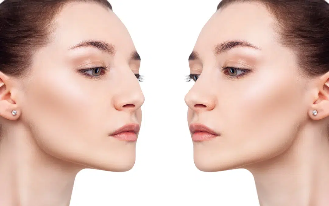 Preparing for your Rhinoplasty Surgery