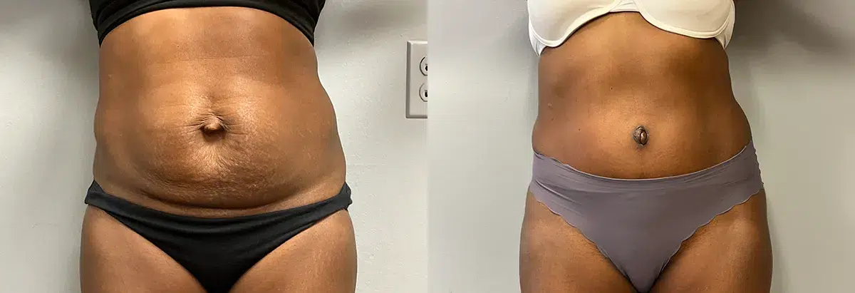 tummy tuck abdominoplasty before and after photo by main line institute of plastic surgery in wynnewood pa