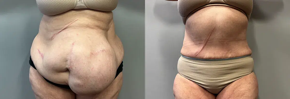 body contouring before and after photo by main line institute of plastic surgery in wynnewood pa