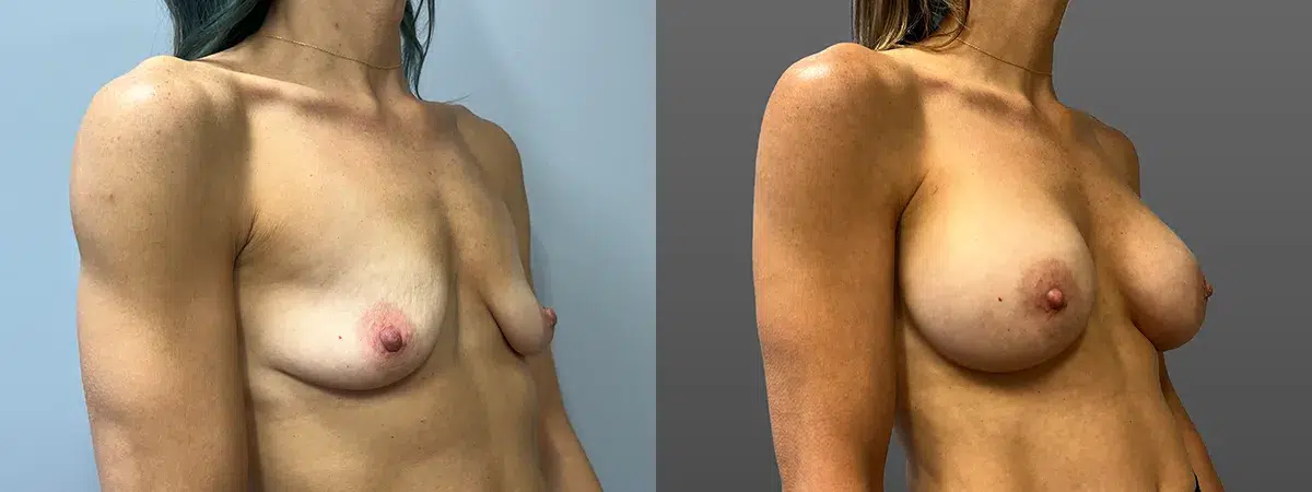 breast augmentation before and after photo by main line institute of plastic surgery in wynnewood pa