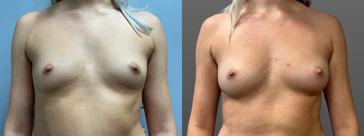breast augmentation with fat grafting before and after photo by main line institute of plastic surgery in wynnewood pa