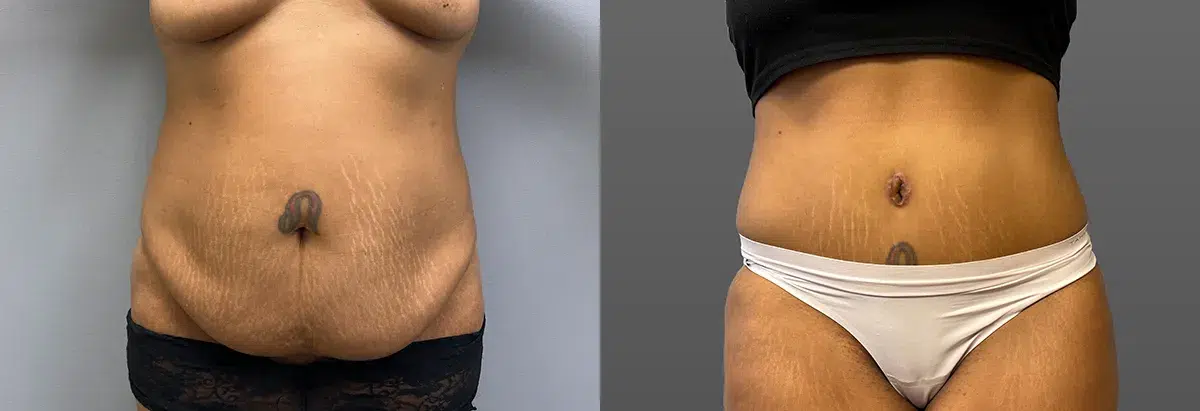 body contouring before and after photo by main line institute of plastic surgery in wynnewood pa