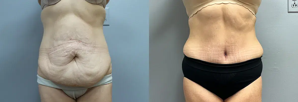 body contouring before and after photo by main line institute of plastic surgery in wynnewood pa