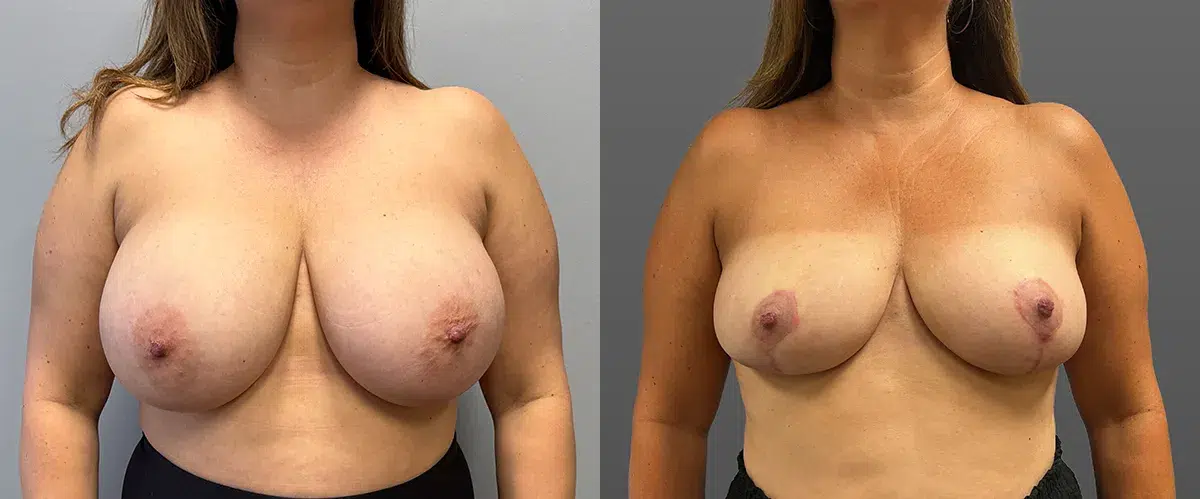 breast reduction before and after photo by main line institute of plastic surgery in wynnewood pa