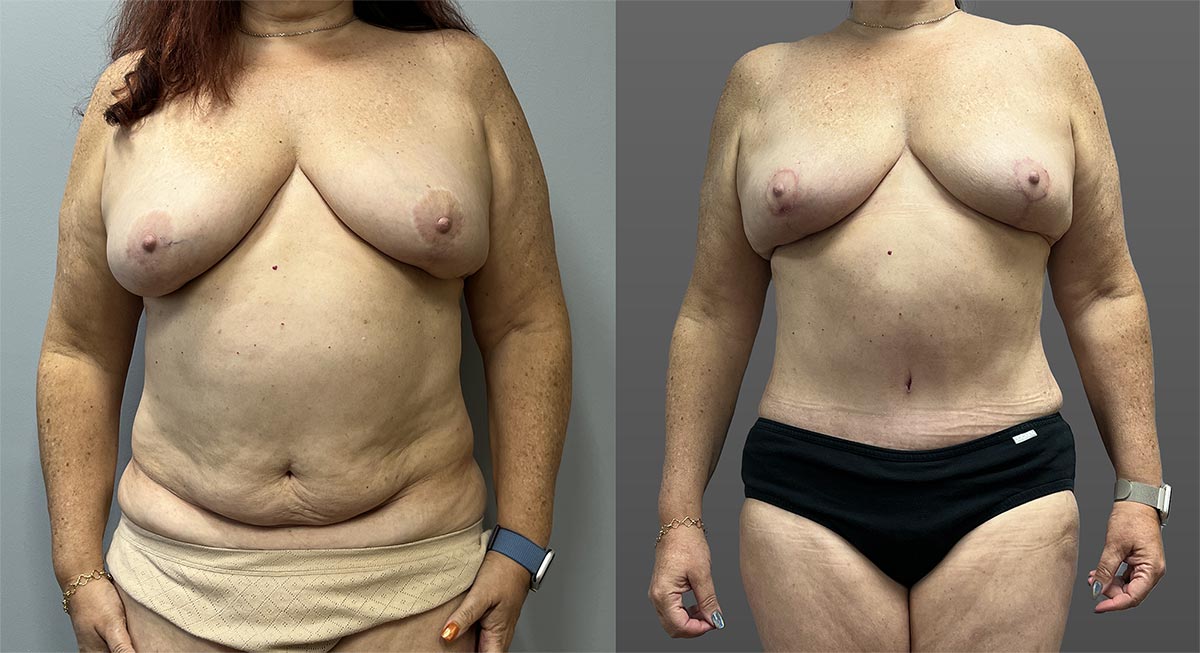 mommy makeover gallery image mommy makeover gallery image