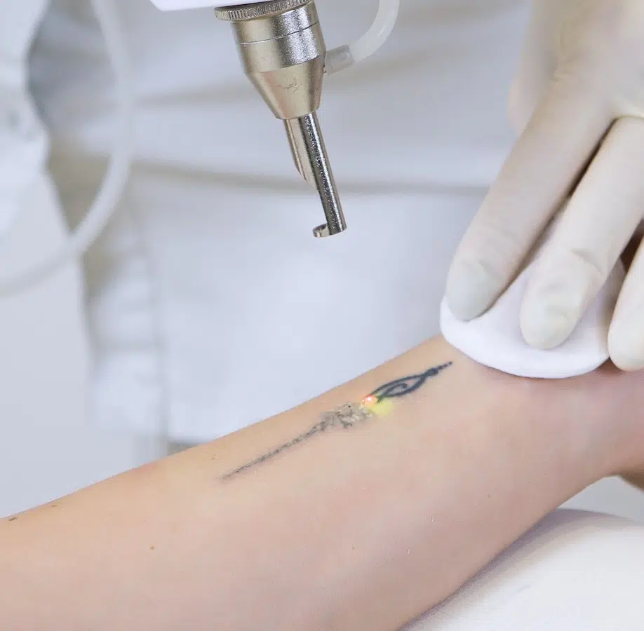 woman receiving tattoo removal treatment