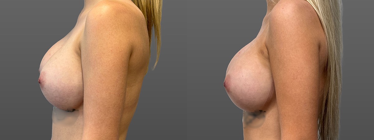 Front View Breast Augmentation Alloclae Before and After Photo by Dr. Hoffman