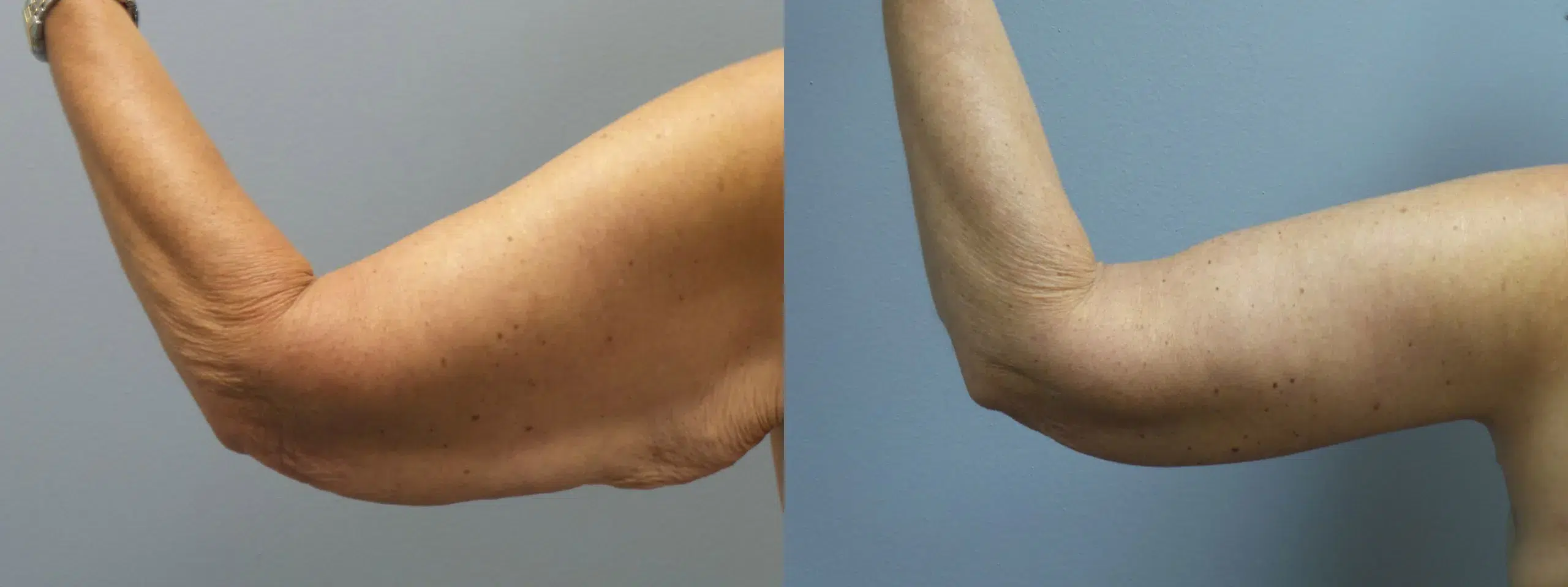 Back Left View Arm Lift Before and After Photo by Dr. Hoffman
