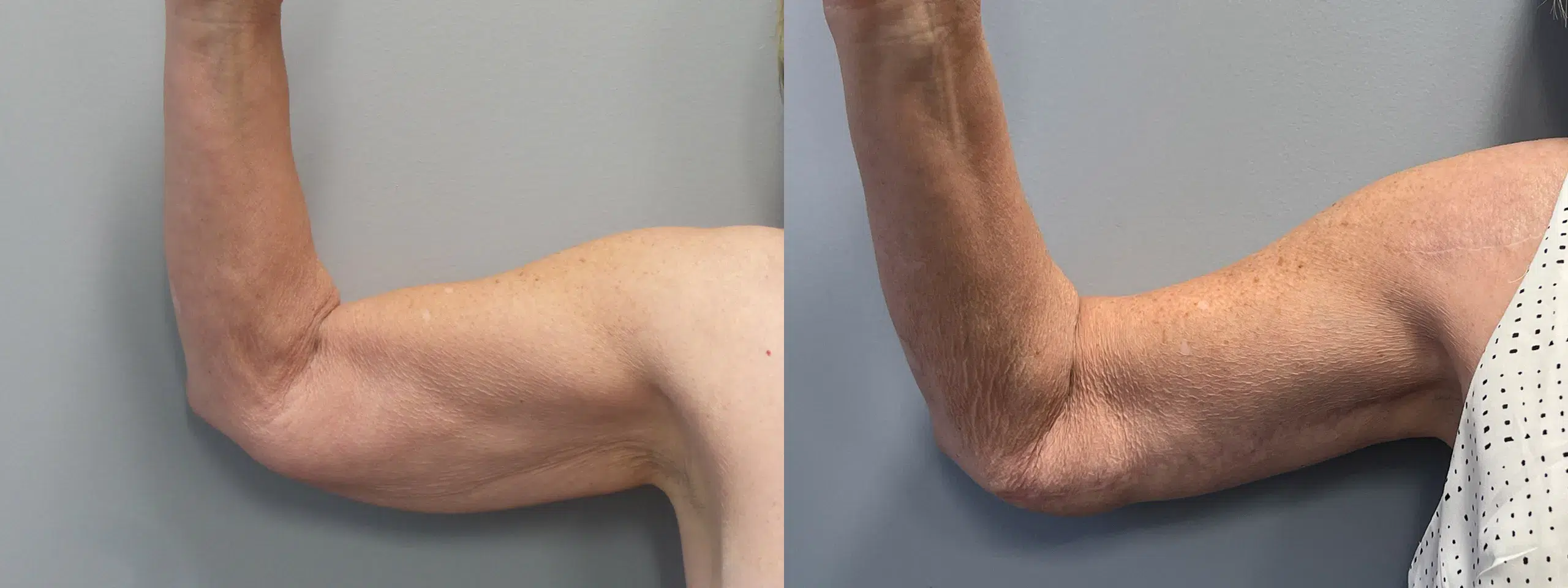 Front Left View Arm Lift Before and After Photo by Dr. Hoffman