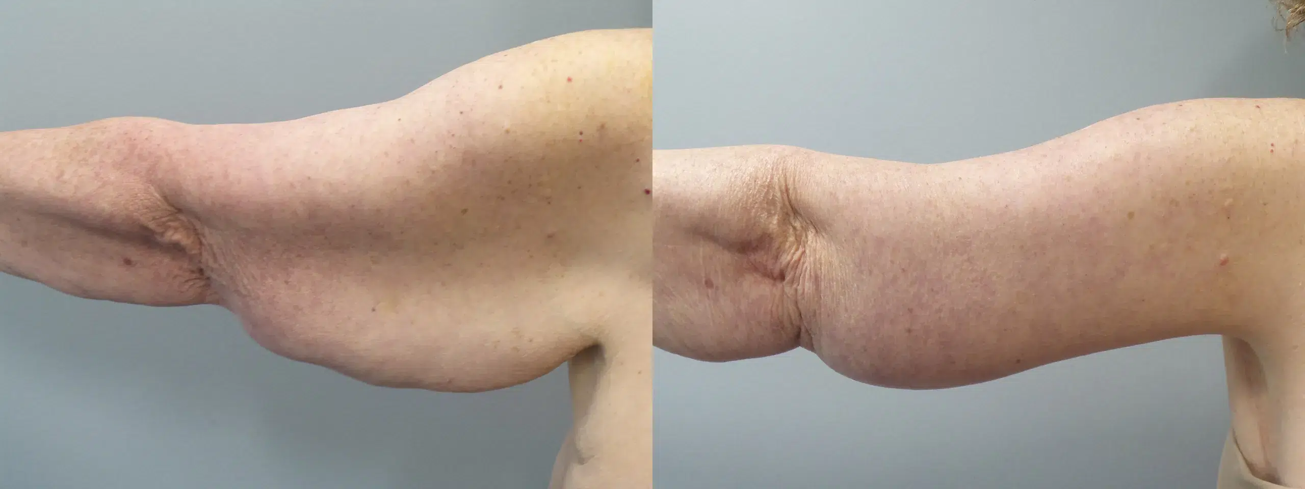 Left View Arm Lift Before and After Photo by Dr. Hoffman