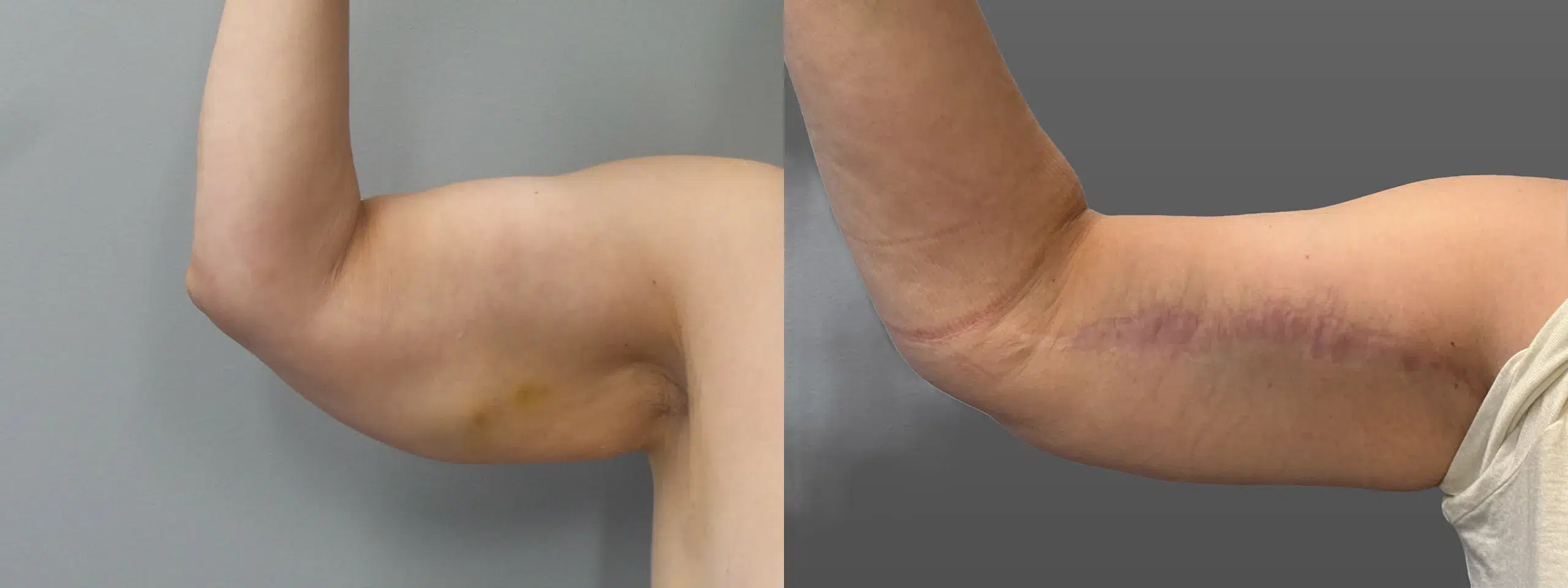 Left View Brachioplasty Before and After Photo by Dr. Hoffman